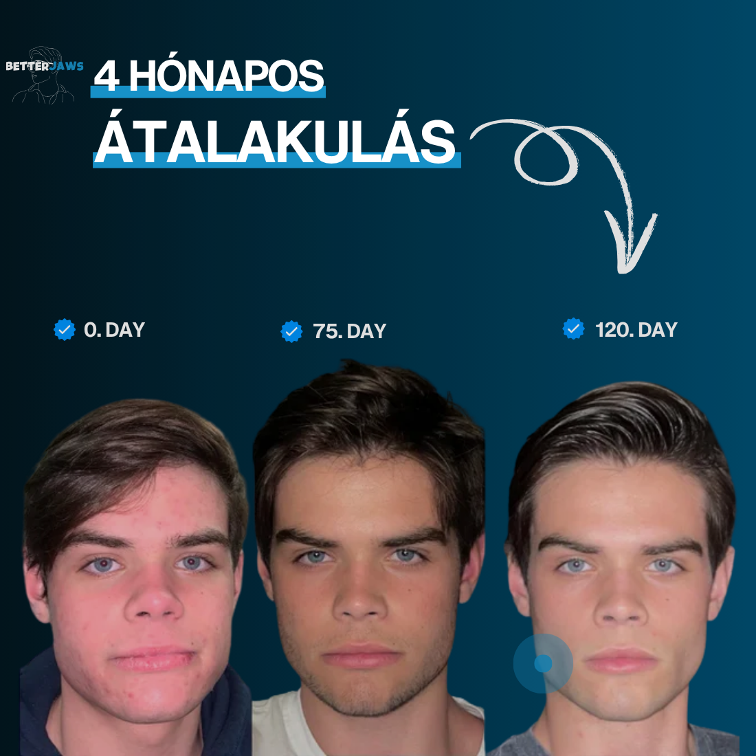 BETTERJAWS™ - Professzionális Állkapocs Erősítő