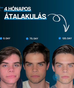 BETTERJAWS™ - Professzionális Állkapocs Erősítő